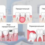 Коллаж вариантов абсцесса зуба