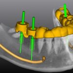 Компьютерное 3D моделирование имплантации зубов