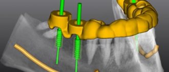 Computer 3D modeling of dental implantation