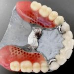 Концевой дефект зубного ряда – особенности протезирования