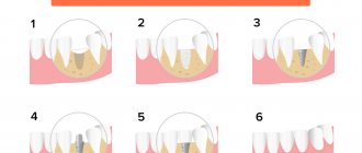 Bone grafting and implant installation in pictures