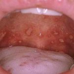 Red and white pimples on the palate of the mouth in an adult and a child photo