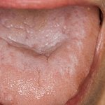 Oral lichen planus