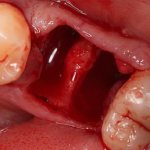 Gums bleed after tooth extraction