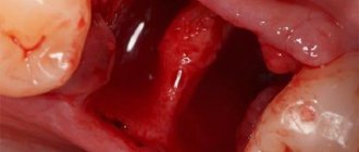 Gums bleed after tooth extraction