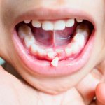 Bleeding of the affected gums - Dentistry &quot;Line of Smile&quot;