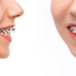 Who can benefit from free installation of braces under compulsory medical insurance?