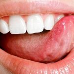 Treatment of aphthous stomatitis in adults