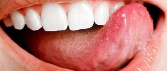 Treatment of aphthous stomatitis in adults