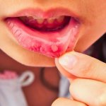 Treatment of herpetic stomatitis at the Family Dentist