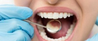 Treatment of dental caries