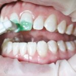 Лечение кариеса зубов методом Icon без сверления в Москве