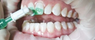 Treatment of dental caries using the Icon method without drilling in Moscow