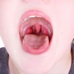 Treatment of tonsils in pus