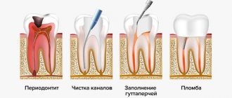 Treatment of periodontitis