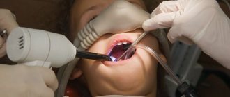 Dental treatment for children under general anesthesia