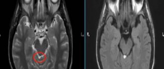 Lipoma of the quadrigeminal cistern on MRI
