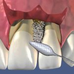 Flap operations in dentistry