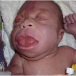 Macroglossia of the tongue in a child