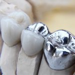 Metal crowns - Dentistry Line Smile