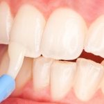 Методы укрепления зубной эмали