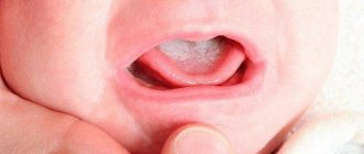Thrush in children&#39;s mouth