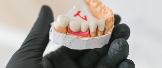 Bridge on chewing teeth made of metal-ceramics for the patient