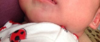 Мозоль на верхней губе у новорожденного