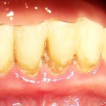 Soft plaque (plaque). Marginal periodontitis 