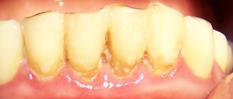Soft plaque (plaque). Marginal periodontitis 
