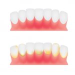 Начальная стадия гингивита – зубной камень