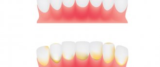 Начальная стадия гингивита – зубной камень