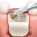 Bone augmentation in dentistry