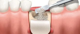 Наращивание костной ткани в стоматологии