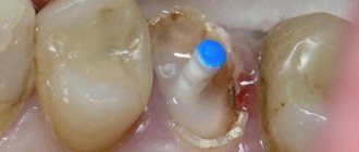Tooth extension onto a pin