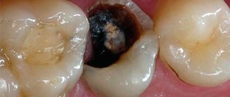 Do not hope that with pulpitis the pain will disappear on its own, because even if this happens, the pulp will rot right in the tooth.