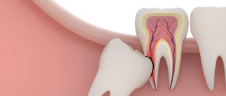 need for wisdom tooth removal