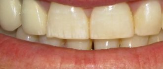 Uneven surface of teeth - Smile Line Dentistry