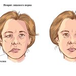 Facial neuritis: symptoms and treatment