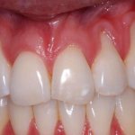 the neck of the tooth is exposed, what to do