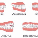 Orthodontic treatment - correction of malocclusion
