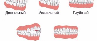Orthodontic treatment - correction of malocclusion