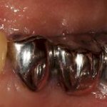 Features of steel crowns on teeth