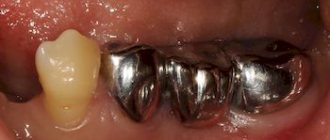 Features of steel crowns on teeth