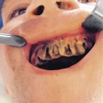 Остеомиелит зубов