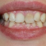 Whitening a pulpless tooth