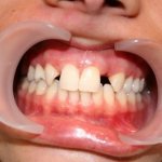 Absence of upper incisors