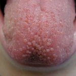 tongue burns treatment