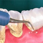 Periodontal cleaning