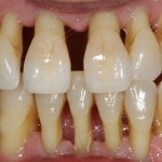 Пародонтоз может привести к потере всех зубов